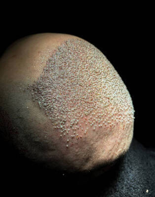 プロフィール｜Hair Transplant Prices in Riyadh